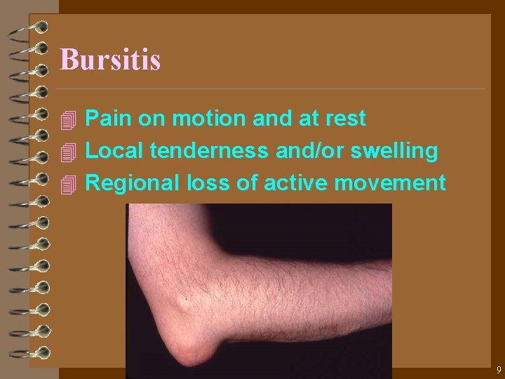 Bursitis 4 Pain on motion and at rest 4 Local tenderness and/or swelling 4