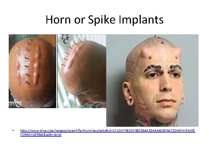 Horn or Spike Implants • http: //www. bing. com/images/search? q=horn+implants&id=1 F 1 D 979