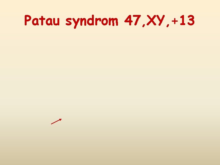 Patau syndrom 47, XY, +13 