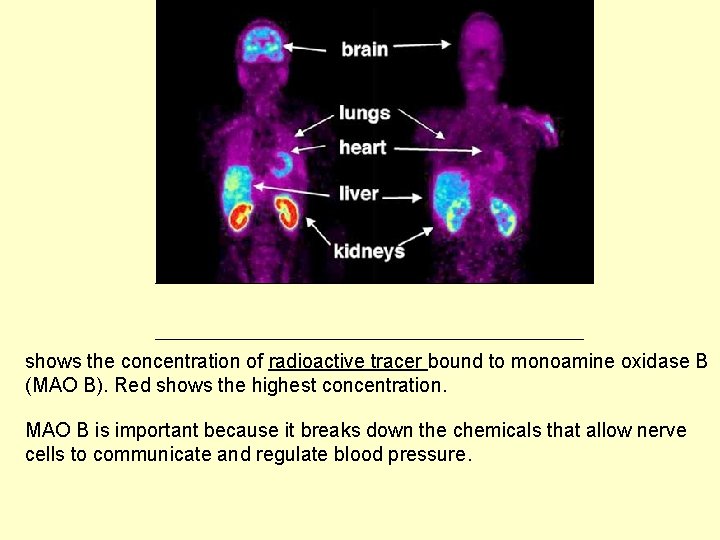 shows the concentration of radioactive tracer bound to monoamine oxidase B (MAO B). Red