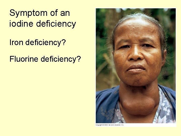 Symptom of an iodine deficiency Iron deficiency? Fluorine deficiency? 