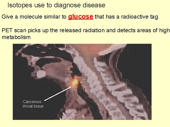 Isotopes use to diagnose disease Give a molecule similar to glucose that has a