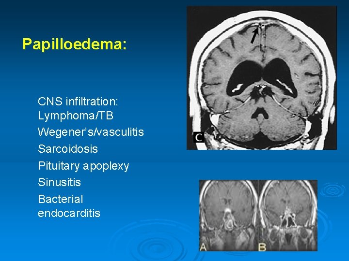 Papilloedema: CNS infiltration: Lymphoma/TB Wegener’s/vasculitis Sarcoidosis Pituitary apoplexy Sinusitis Bacterial endocarditis 