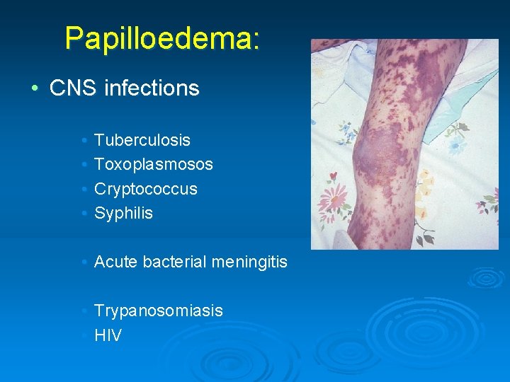Papilloedema: • CNS infections • • Tuberculosis Toxoplasmosos Cryptococcus Syphilis • Acute bacterial meningitis