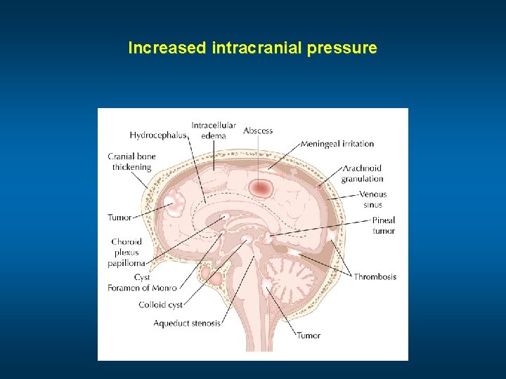 Increased intracranial pressure 