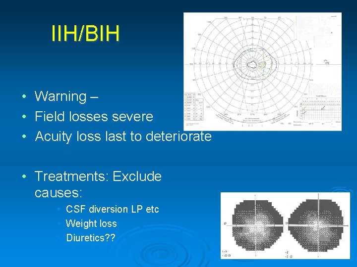 IIH/BIH • Warning – • Field losses severe • Acuity loss last to deteriorate