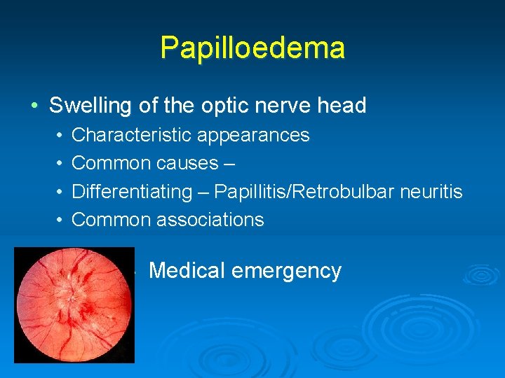 Papilloedema • Swelling of the optic nerve head • • Characteristic appearances Common causes