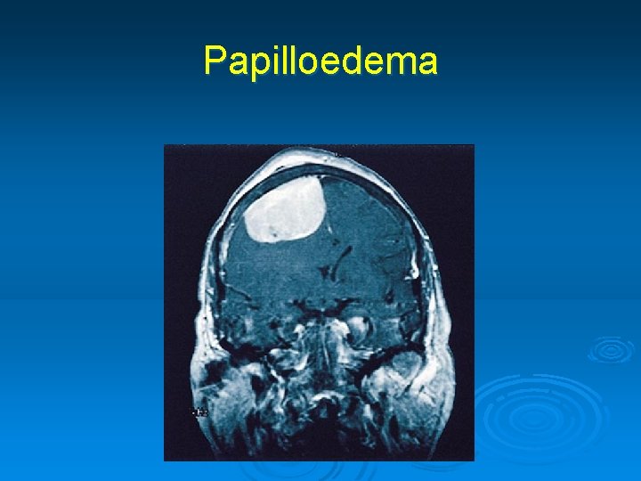 Papilloedema 