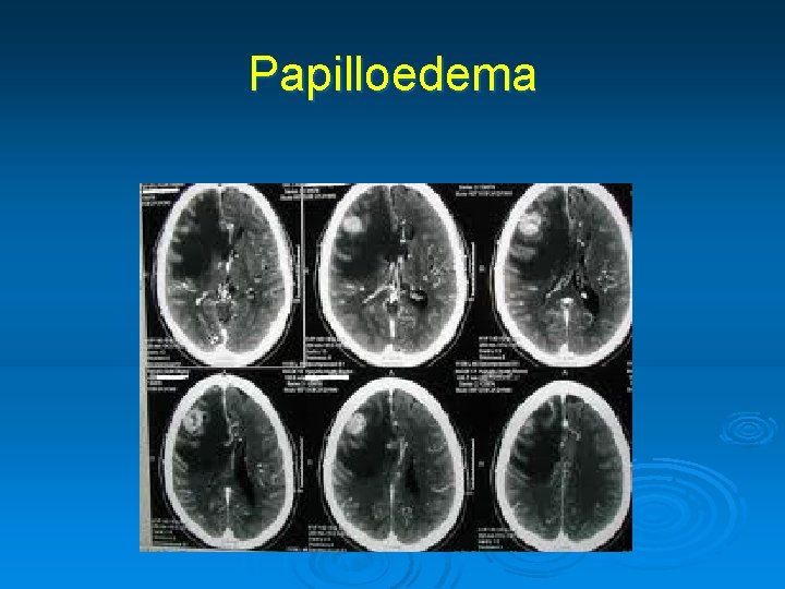 Papilloedema 