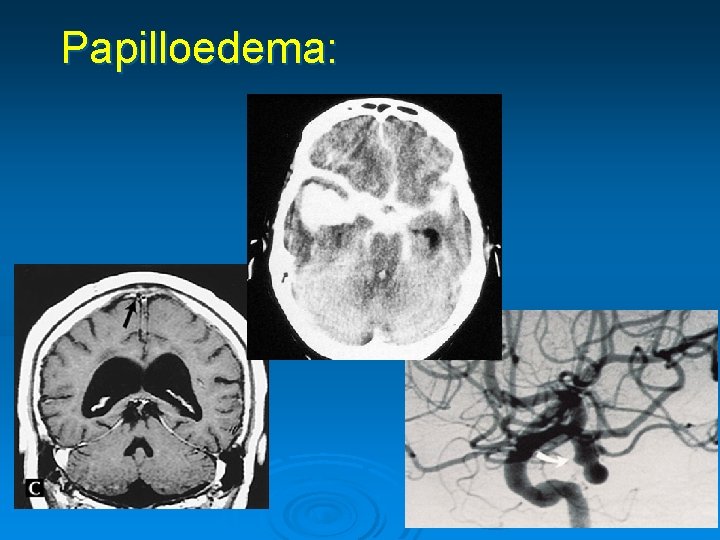 Papilloedema: 