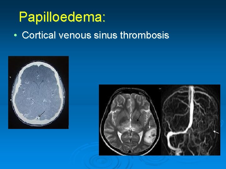 Papilloedema: • Cortical venous sinus thrombosis 