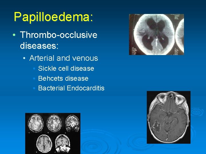 Papilloedema: • Thrombo-occlusive diseases: • Arterial and venous • Sickle cell disease • Behcets