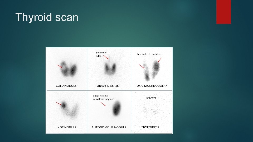 Thyroid scan 