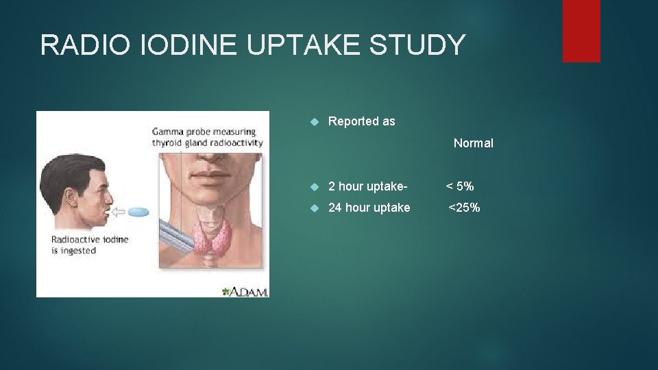 RADIO IODINE UPTAKE STUDY Reported as Normal 2 hour uptake- < 5% 24 hour