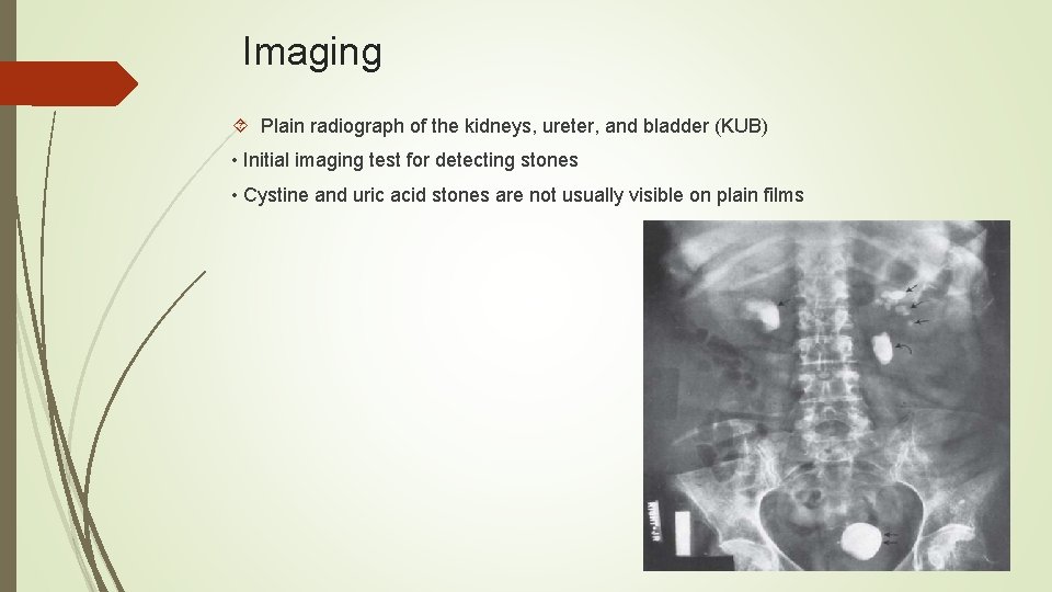 Imaging Plain radiograph of the kidneys, ureter, and bladder (KUB) • Initial imaging test