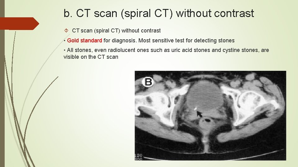 b. CT scan (spiral CT) without contrast • Gold standard for diagnosis. Most sensitive