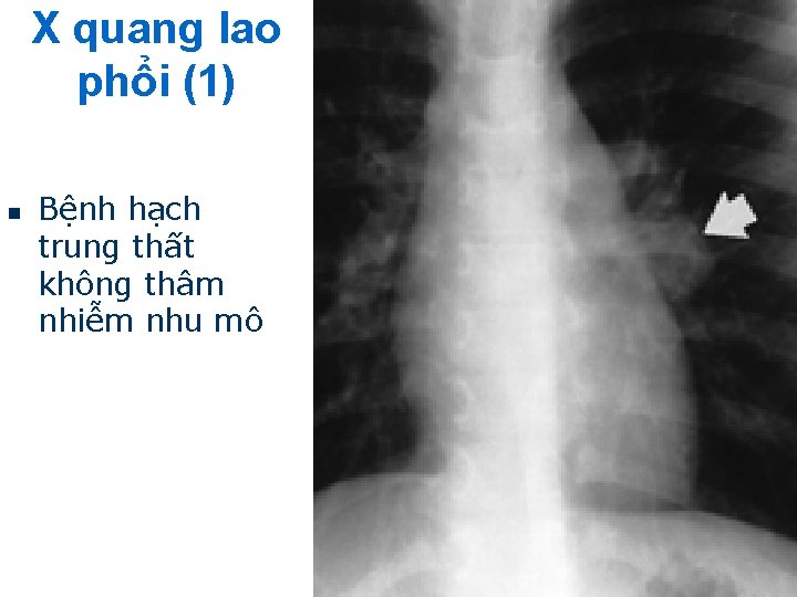 X quang lao phổi (1) n Bệnh hạch trung thất không thâm nhiễm nhu