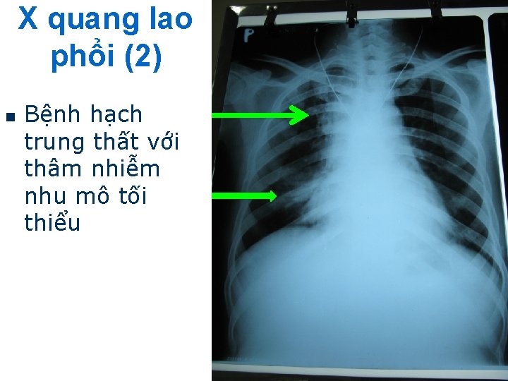 X quang lao phổi (2) n Bệnh hạch trung thất với thâm nhiễm nhu