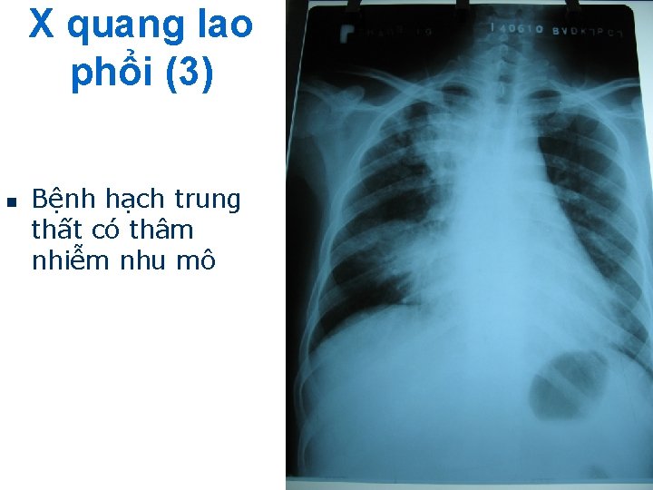 X quang lao phổi (3) n Bệnh hạch trung thất có thâm nhiễm nhu