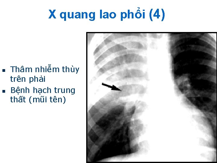 X quang lao phổi (4) n n Thâm nhiễm thùy trên phải Bệnh hạch