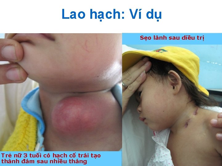 Lao hạch: Ví dụ Sẹo lành sau diều trị Trẻ nữ 3 tuổi có