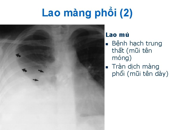 Lao màng phổi (2) Lao mủ n Bệnh hạch trung thất (mũi tên mỏng)