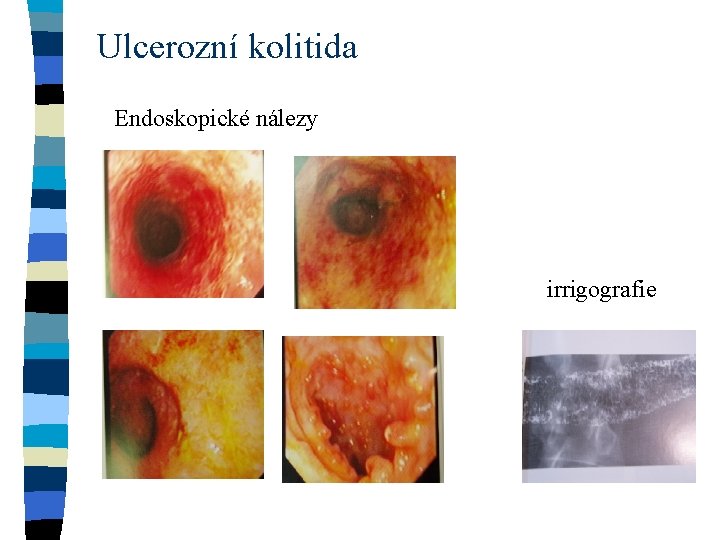 Ulcerozní kolitida Endoskopické nálezy irrigografie 