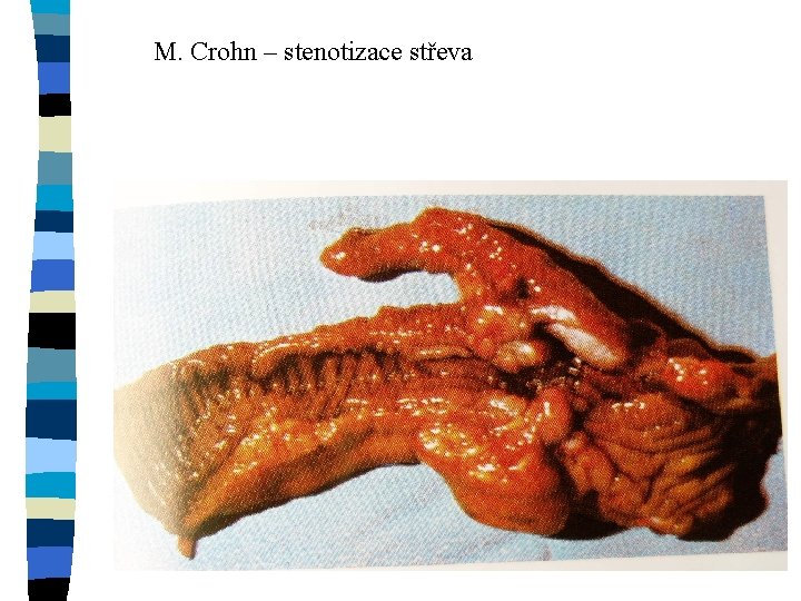 M. Crohn – stenotizace střeva 