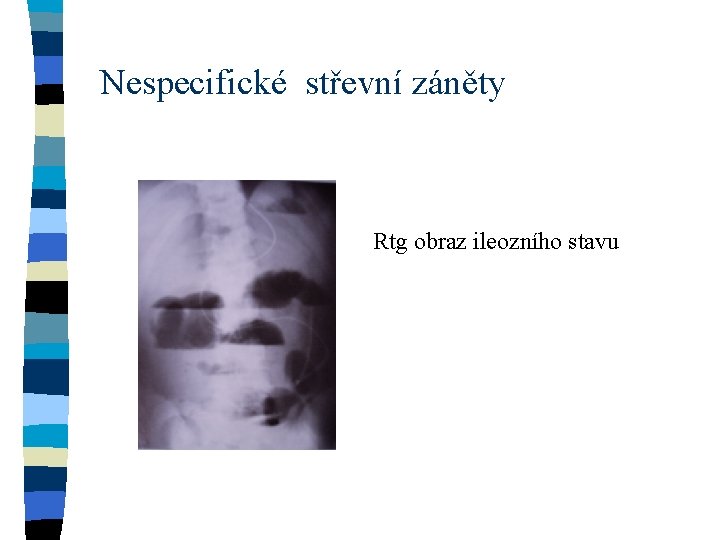 Nespecifické střevní záněty Rtg obraz ileozního stavu 