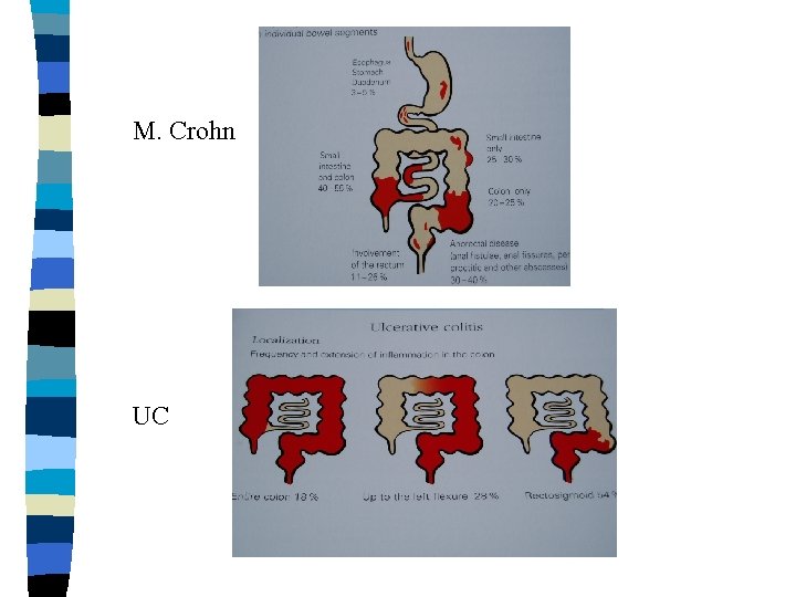 M. Crohn UC 