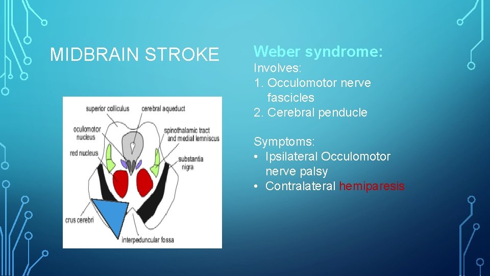 MIDBRAIN STROKE Weber syndrome: Involves: 1. Occulomotor nerve fascicles 2. Cerebral penducle Symptoms: •