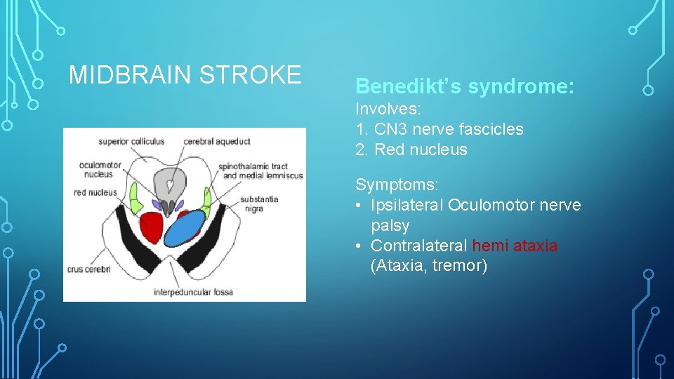 MIDBRAIN STROKE Benedikt’s syndrome: Involves: 1. CN 3 nerve fascicles 2. Red nucleus Symptoms: