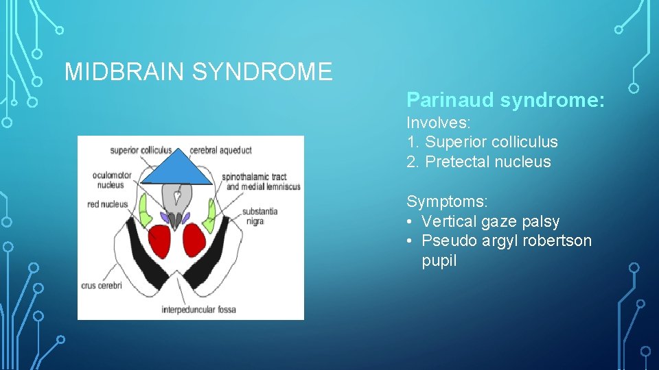 MIDBRAIN SYNDROME Parinaud syndrome: Involves: 1. Superior colliculus 2. Pretectal nucleus Symptoms: • Vertical