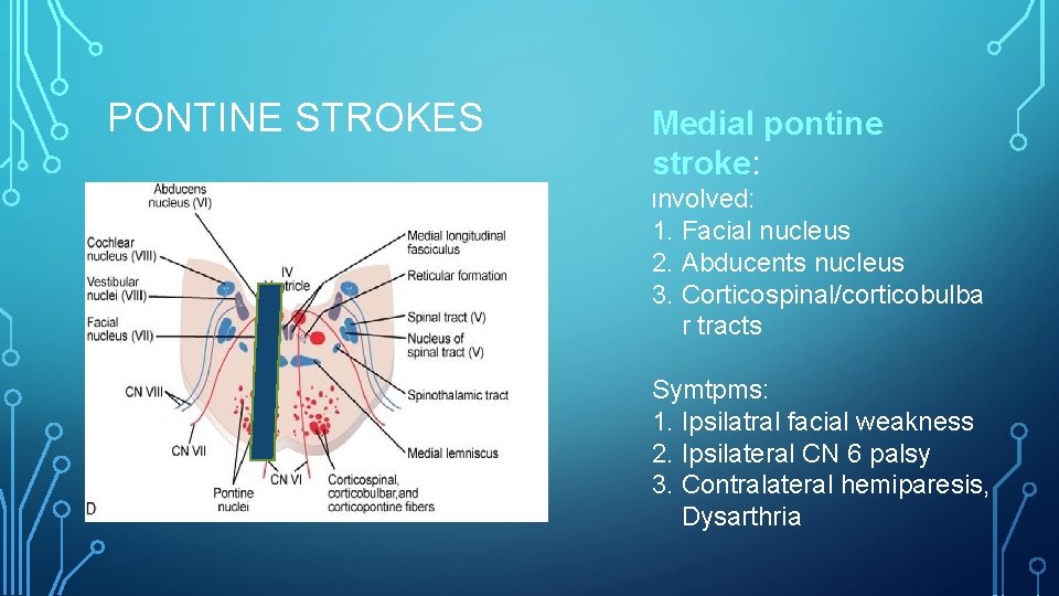 PONTINE STROKES Medial pontine stroke: Involved: 1. Facial nucleus 2. Abducents nucleus 3. Corticospinal/corticobulba