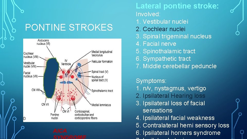 Lateral pontine stroke: PONTINE STROKES AICA Involved: 1. Vestibular nuclei 2. Cochlear nuclei 3.