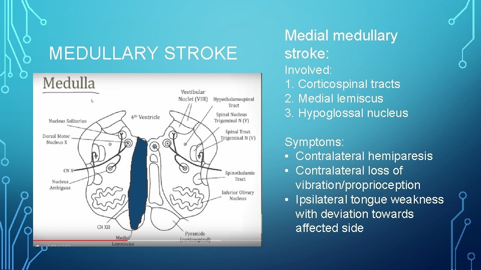 MEDULLARY STROKE Medial medullary stroke: Involved: 1. Corticospinal tracts 2. Medial lemiscus 3. Hypoglossal