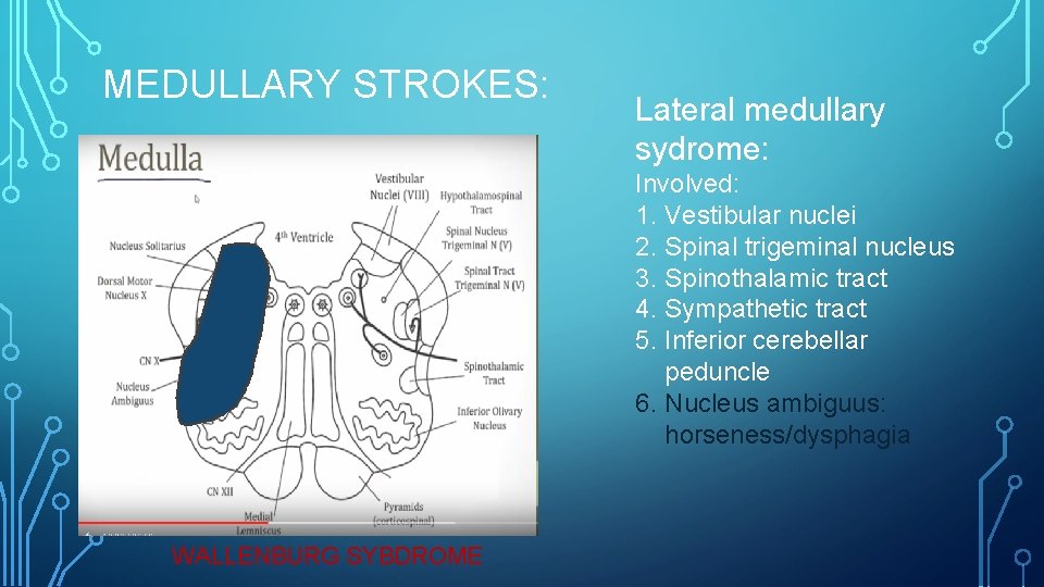 MEDULLARY STROKES: Lateral medullary sydrome: Involved: 1. Vestibular nuclei 2. Spinal trigeminal nucleus 3.