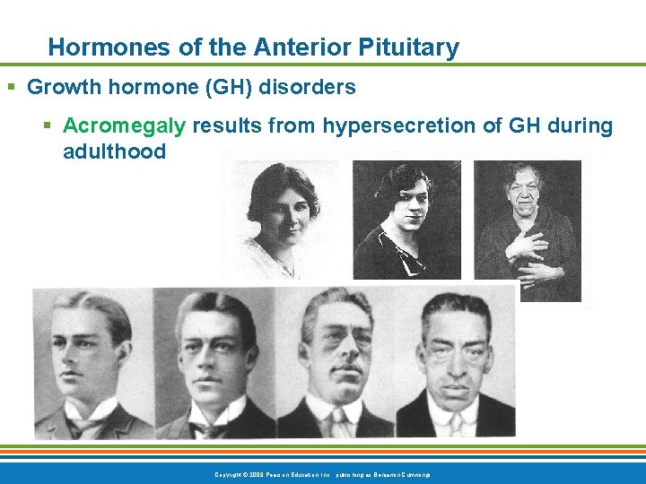 Hormones of the Anterior Pituitary § Growth hormone (GH) disorders § Acromegaly results from