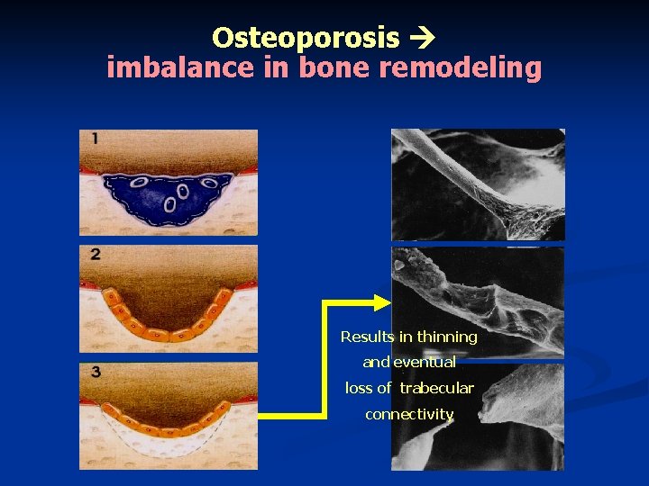 Osteoporosis imbalance in bone remodeling Results in thinning and eventual loss of trabecular connectivity