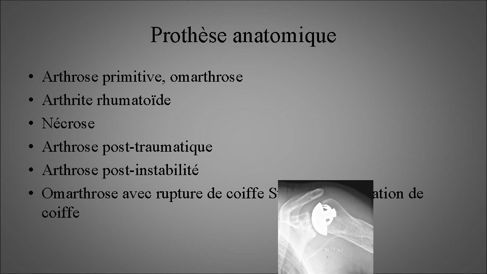 Prothèse anatomique • • • Arthrose primitive, omarthrose Arthrite rhumatoïde Nécrose Arthrose post-traumatique Arthrose