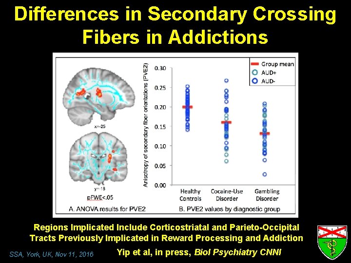 Differences in Secondary Crossing Fibers in Addictions Regions Implicated Include Corticostriatal and Parieto-Occipital Tracts