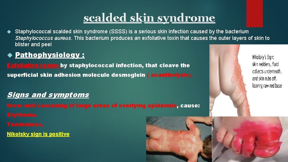 scalded skin syndrome Staphylococcal scalded skin syndrome (SSSS) is a serious skin infection caused