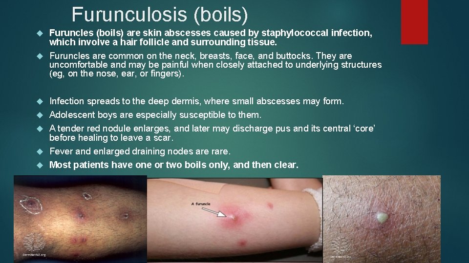 Furunculosis (boils) Furuncles (boils) are skin abscesses caused by staphylococcal infection, which involve a