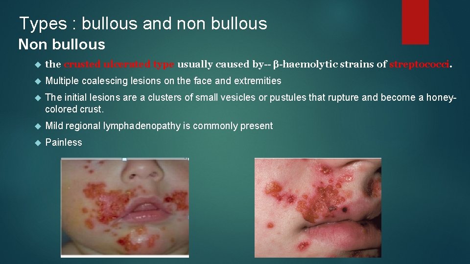 Types : bullous and non bullous Non bullous the crusted ulcerated type usually caused