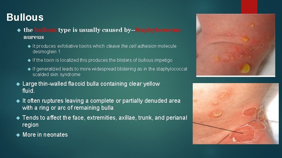 Bullous the bullous type is usually caused by--Staphylococcus aureus It produces exfoliative toxins which