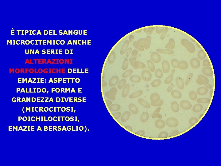 È TIPICA DEL SANGUE MICROCITEMICO ANCHE UNA SERIE DI ALTERAZIONI MORFOLOGICHE DELLE EMAZIE: ASPETTO