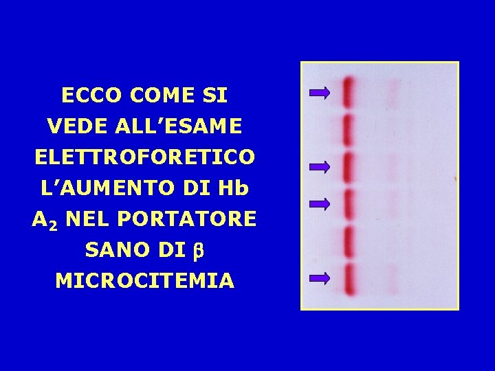 ECCO COME SI VEDE ALL’ESAME ELETTROFORETICO L’AUMENTO DI Hb A 2 NEL PORTATORE SANO