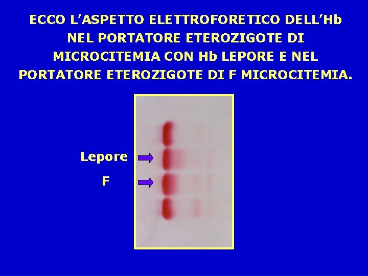 ECCO L’ASPETTO ELETTROFORETICO DELL’Hb NEL PORTATORE ETEROZIGOTE DI MICROCITEMIA CON Hb LEPORE E NEL