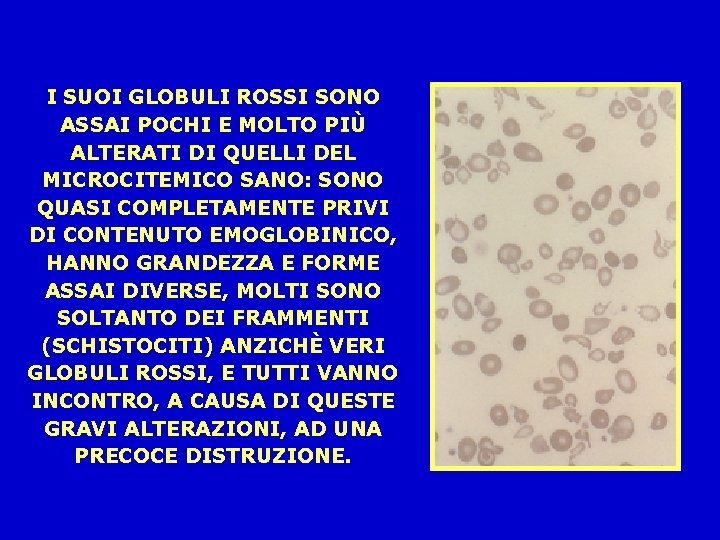 I SUOI GLOBULI ROSSI SONO ASSAI POCHI E MOLTO PIÙ ALTERATI DI QUELLI DEL