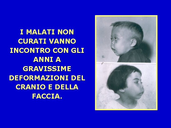 I MALATI NON CURATI VANNO INCONTRO CON GLI ANNI A GRAVISSIME DEFORMAZIONI DEL CRANIO